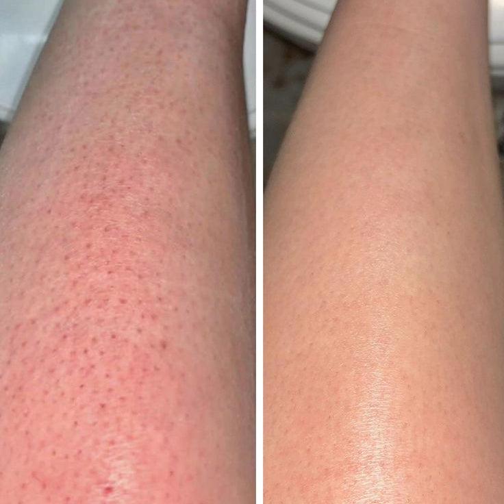 Peau de fraise : causes, solutions et le rituel qui change vraiment les choses
